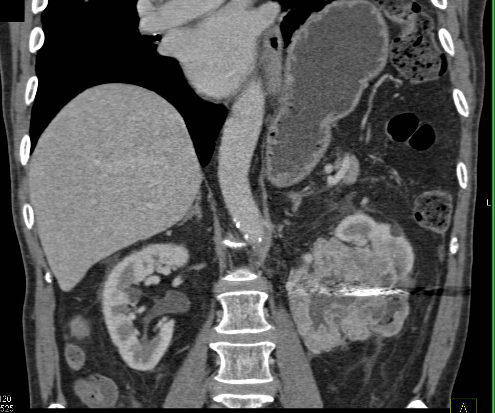 Clear Cell Renal Cell Carcinoma s/p Embolization - CTisus CT Scan
