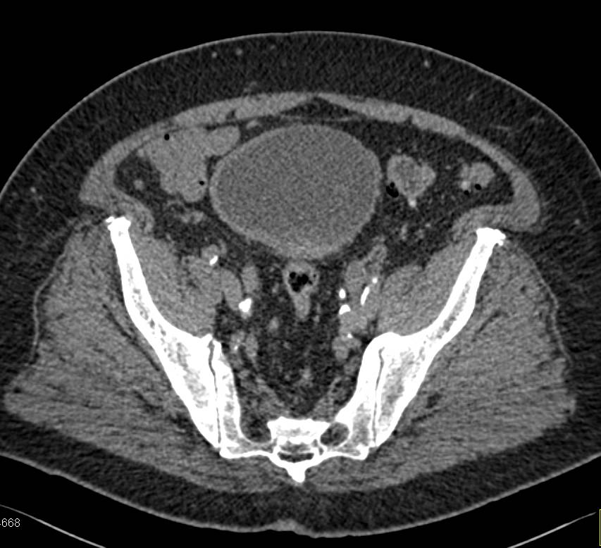 Right Sided Bladder Cancer - CTisus CT Scan