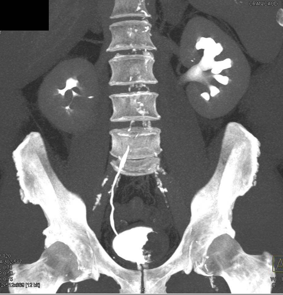 Bladder Cancer Invades the Distal Left Ureter - CTisus CT Scan