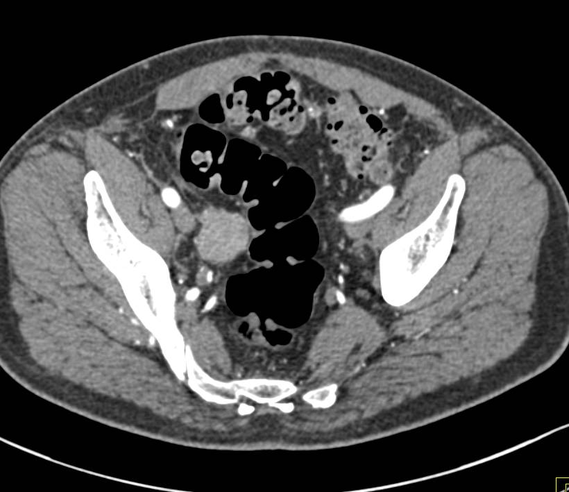 Tumor Implant in Right Lower Quadrant - CTisus CT Scan