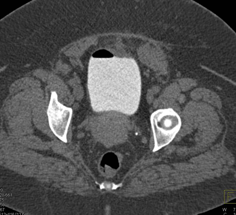 CT Cystogram with Colovesical Fistula - CTisus CT Scan