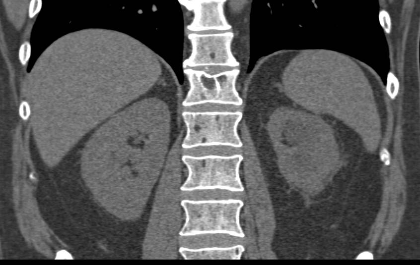 Bladder Cancer Obstructs the Left Kidney - CTisus CT Scan