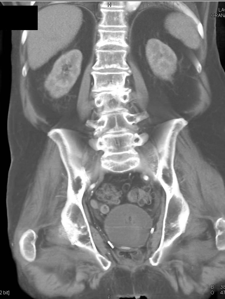 Normal Bladder - CTisus CT Scan