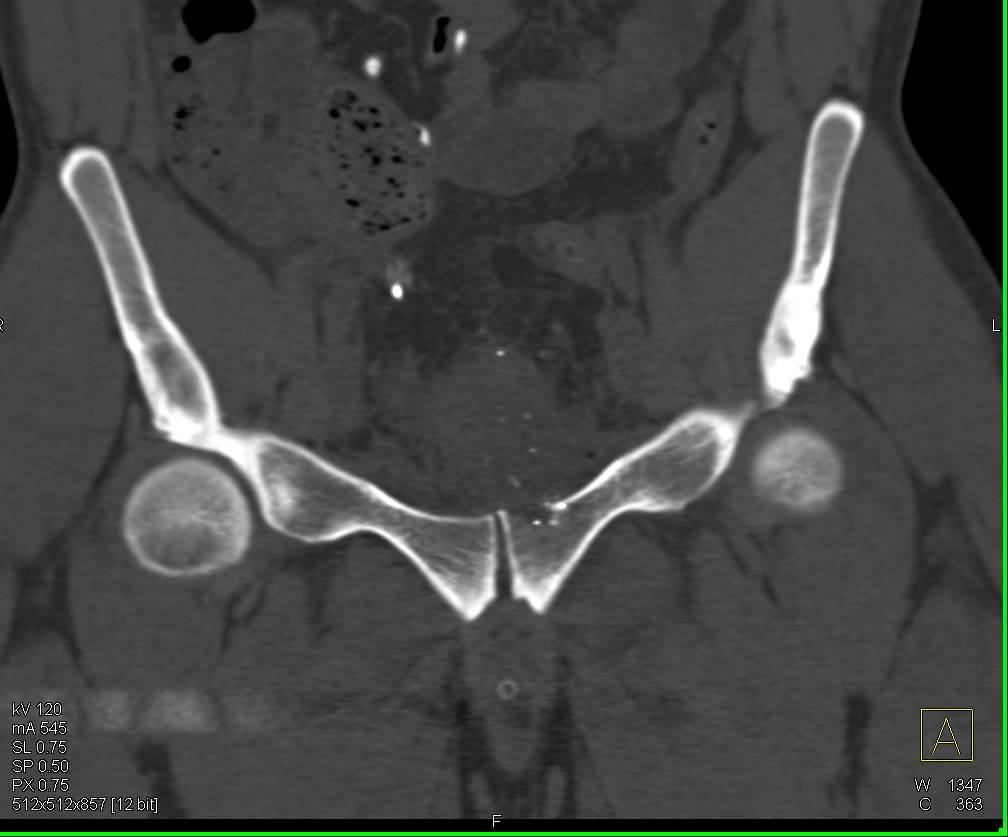 GSW Symphysis with Injury to Bladder on CT Cystogram - CTisus CT Scan