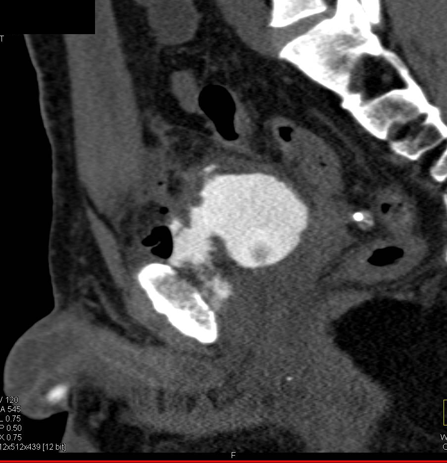 Bladder Laceration due to Pelvic Trauma as Seen on CT Cystogram - CTisus CT Scan