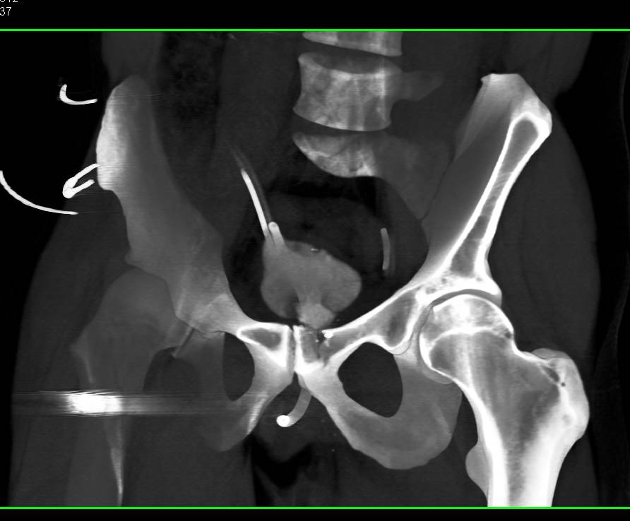 GSW Pelvis with Symphysis Fracture and Bladder Laceration with Leak on CT Cystogram - CTisus CT Scan