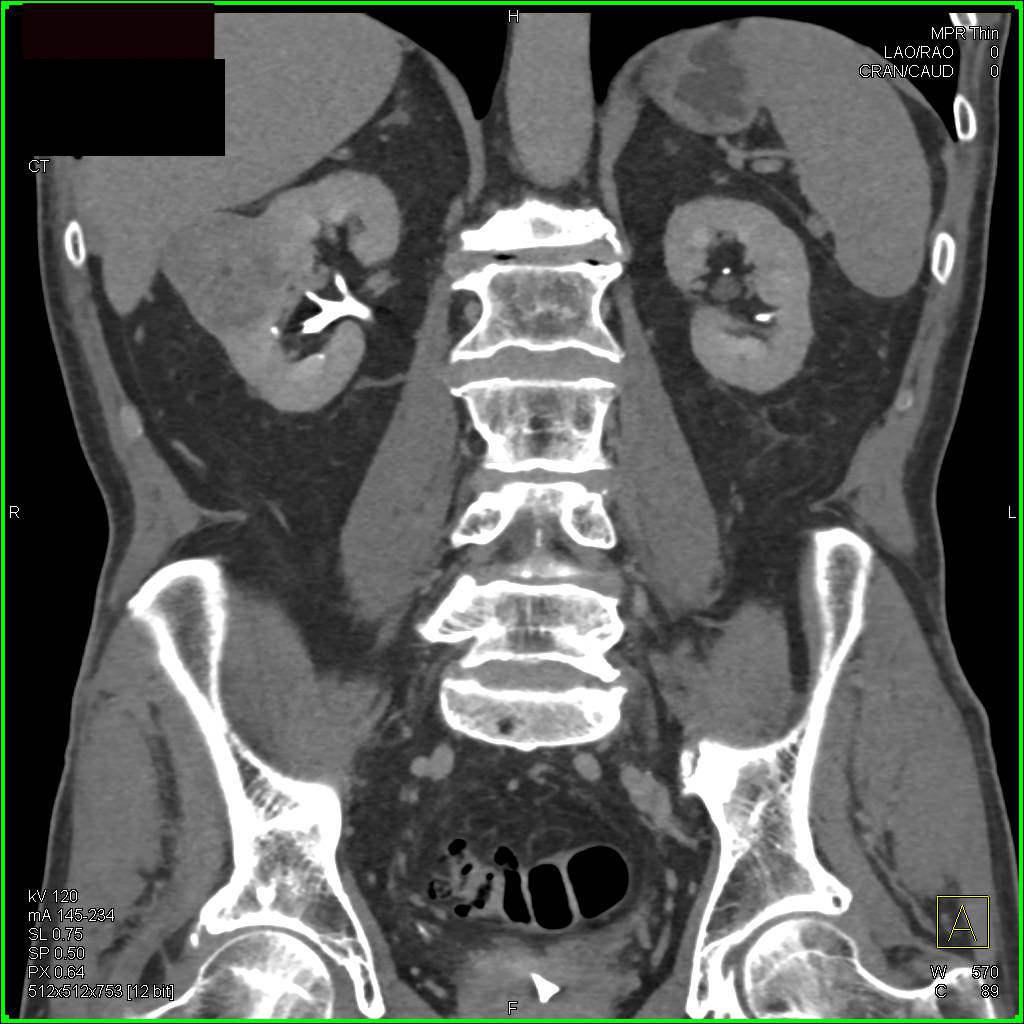 Clear Cell Renal Cell Carcinoma with Neovascularity Simulates a Oncocytoma - CTisus CT Scan