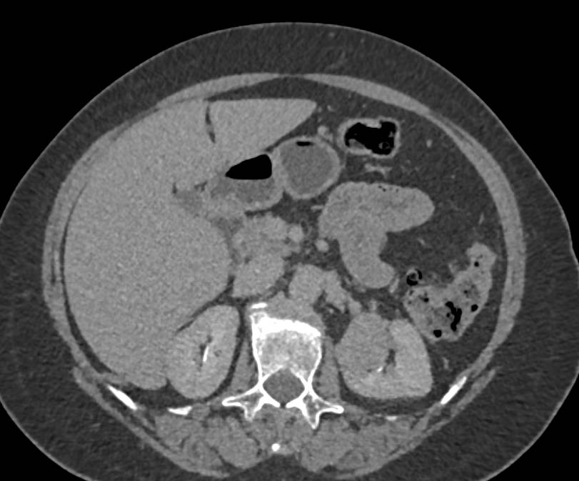 Incidental Papillary Renal Cell Carcinoma Left Kidney - CTisus CT Scan