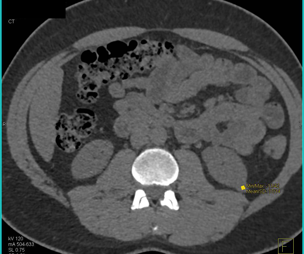 Bladder Cancer in Various Phases - CTisus CT Scan