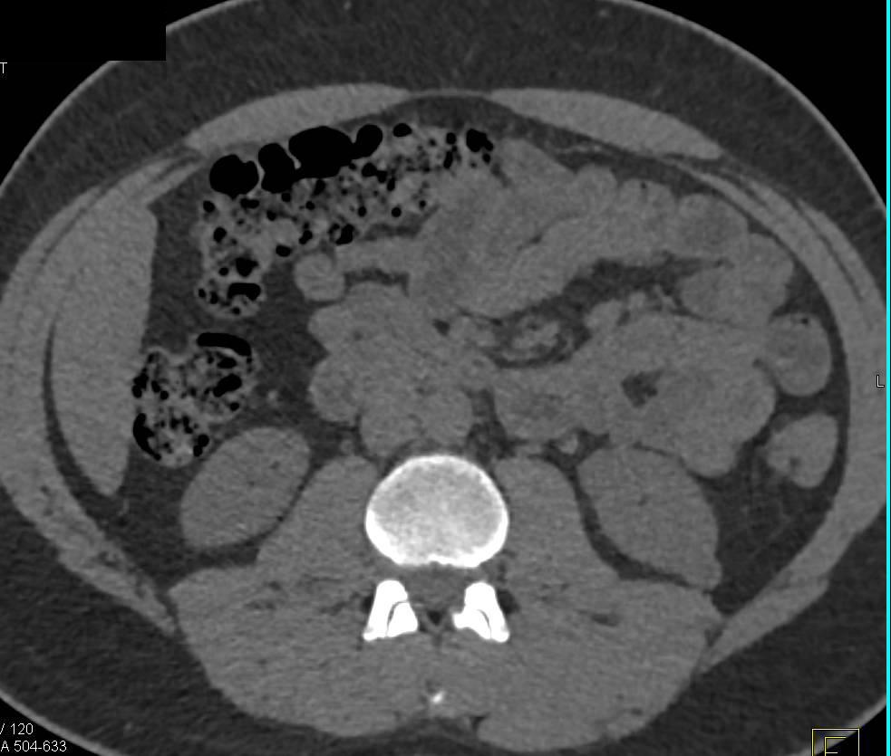 Incidental Right Sided Bladder Cancer - CTisus CT Scan