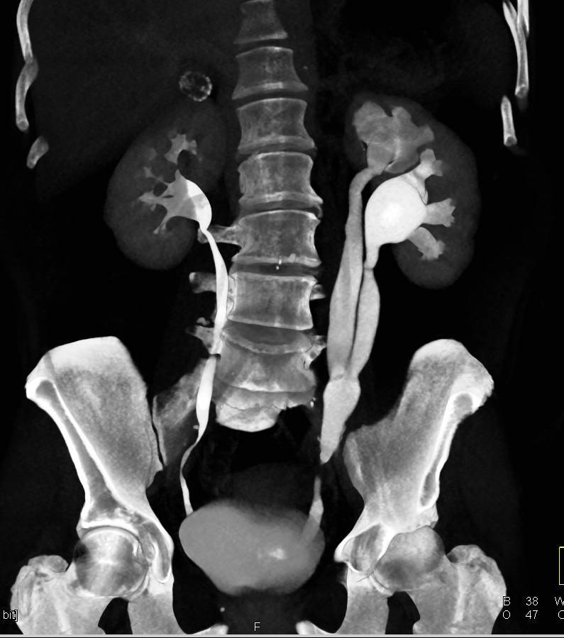 Duplicated and Obstructed Left Collecting System due to Ureteral Calculi - CTisus CT Scan