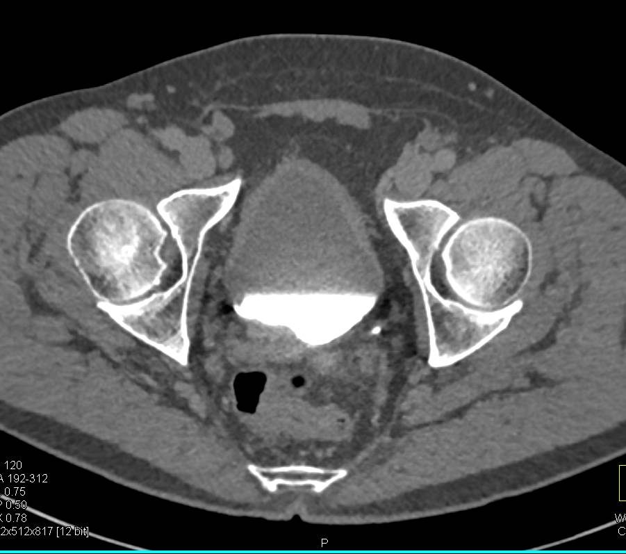 Subtle Right Bladder Cancer - CTisus CT Scan