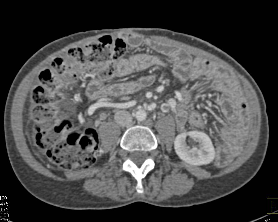 Left Gonadal Vein Thrombosis and Thickened Small Bowel Loops - CTisus CT Scan