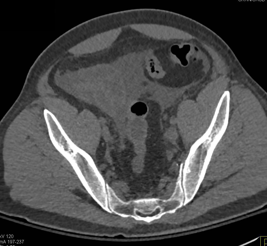 CT Cystogram with Leak s/p Laparoscopic Prostatectomy - CTisus CT Scan