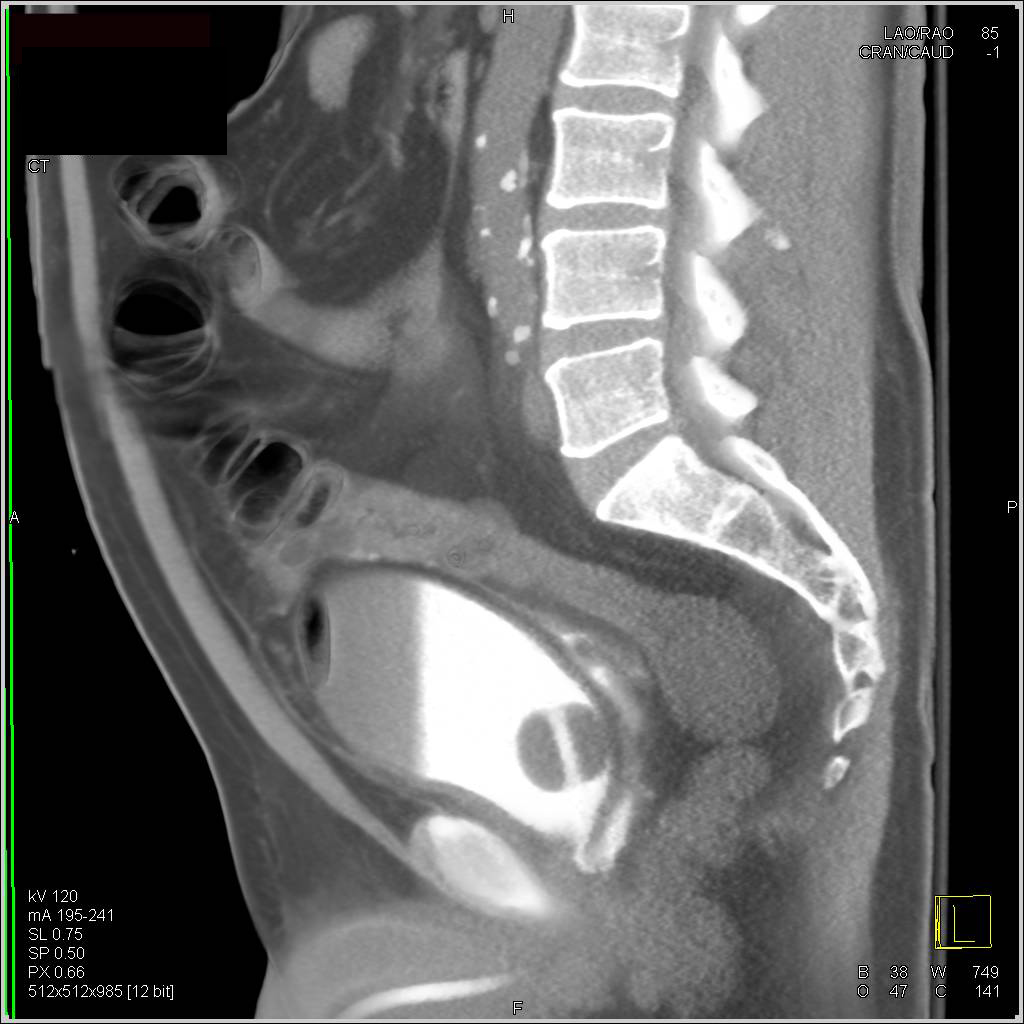 CT Cystogram with Leak s/p Laparoscopic Prostatectomy that is Intraperitoneal - CTisus CT Scan