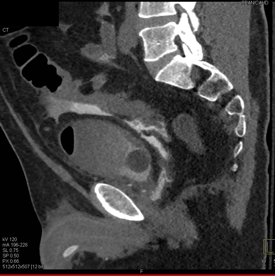 Bladder Perforation with Intraperitoneal Extravasation - CTisus CT Scan