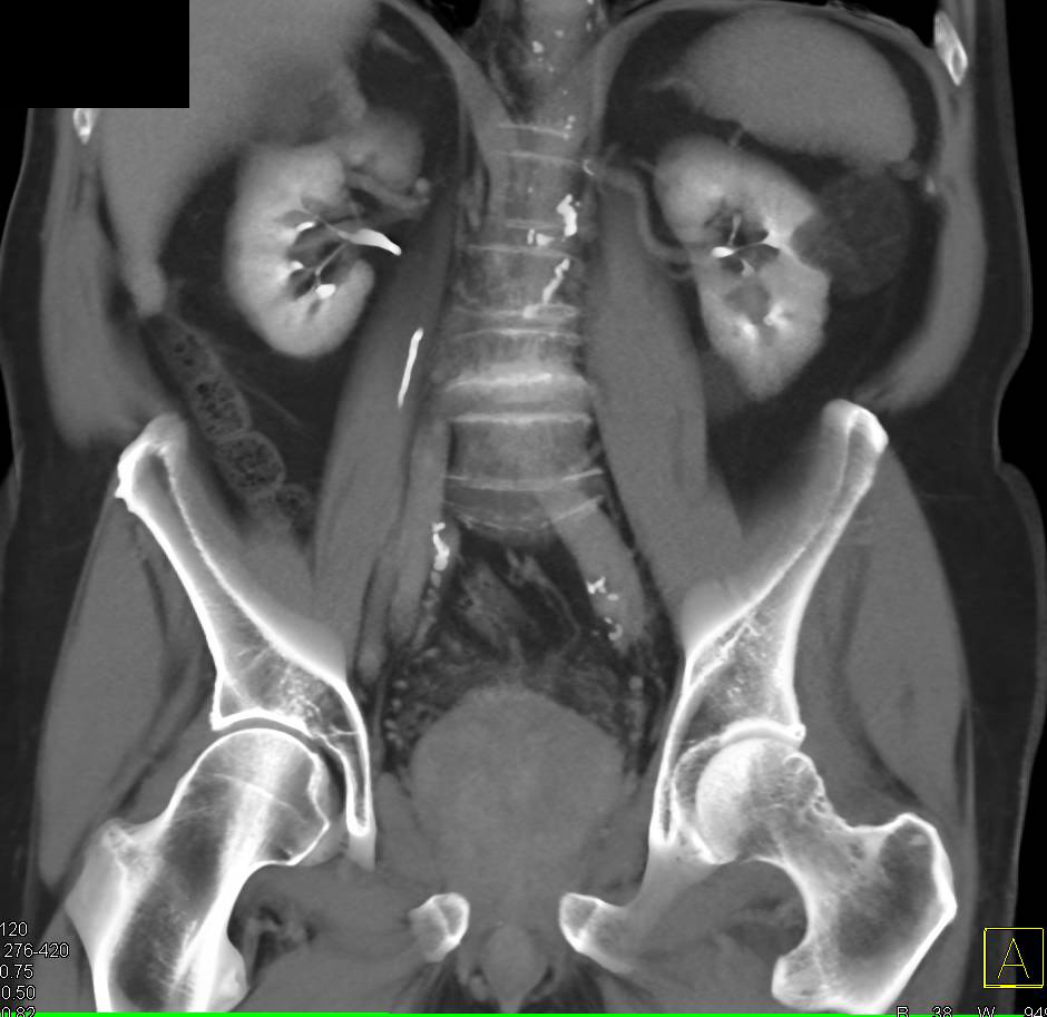 Left Renal Angiomyolipoma - CTisus CT Scan