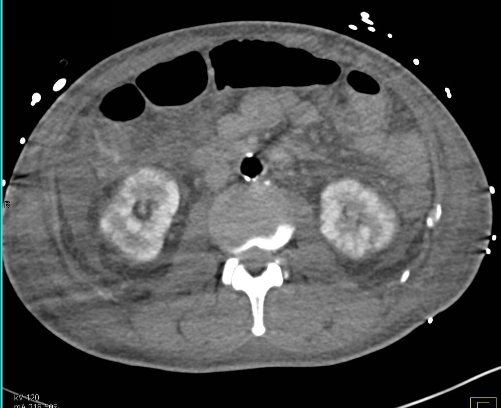 Intra-arterial Pump with Poor Perfusion of the Kidneys - CTisus CT Scan