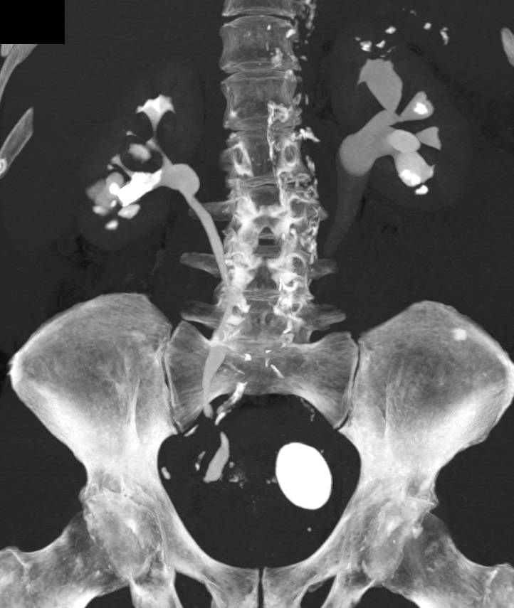 Multifocal Transitional Cell Carcinoma as Well as Left Bladder Calculus - CTisus CT Scan