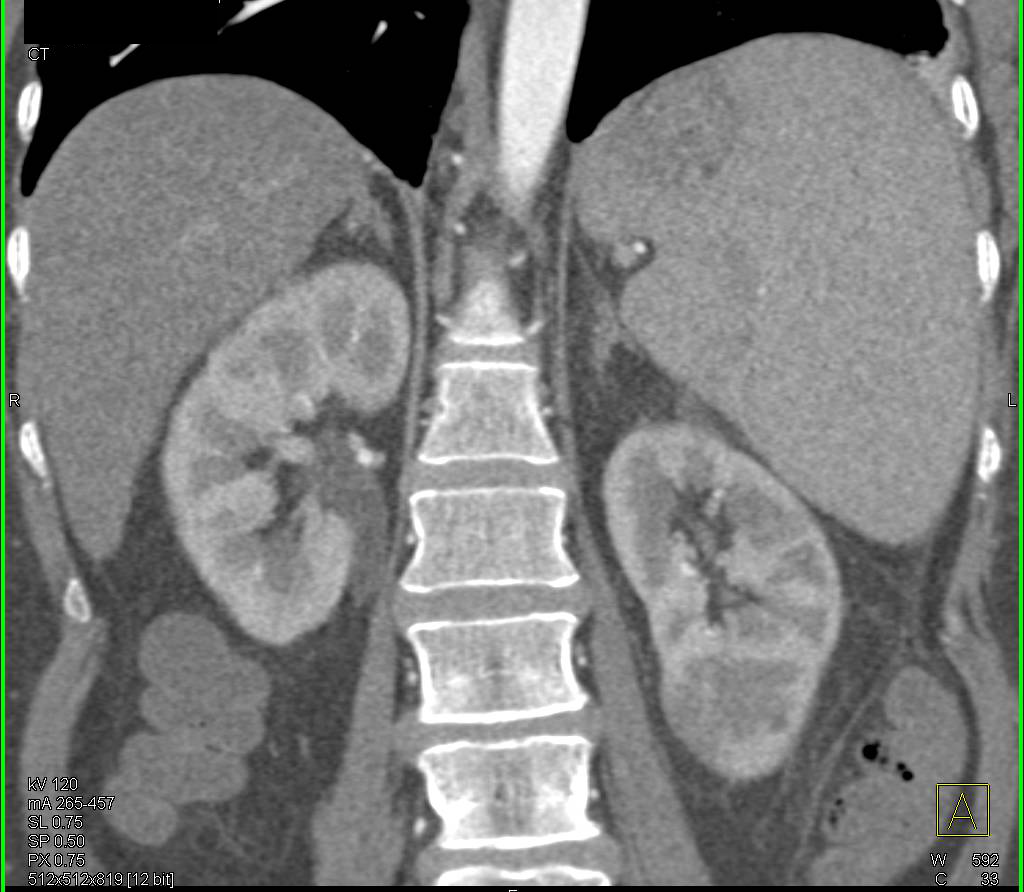 Lymphoma with Renal Involvement - CTisus CT Scan