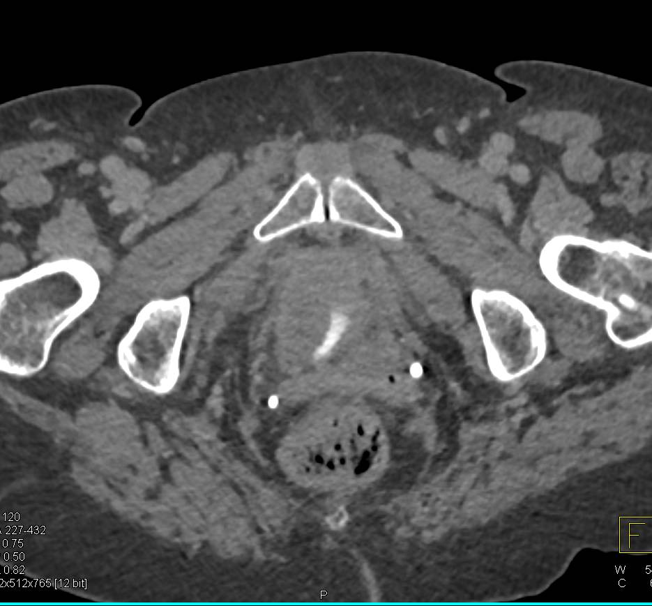 Incidental Pulmonary Embolism (PE) in Patient with Suspected Bladder cancer - CTisus CT Scan