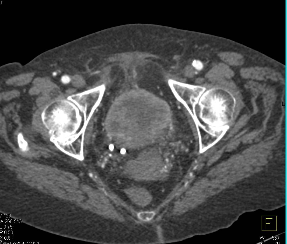 Bulky Bladder Cancer - CTisus CT Scan