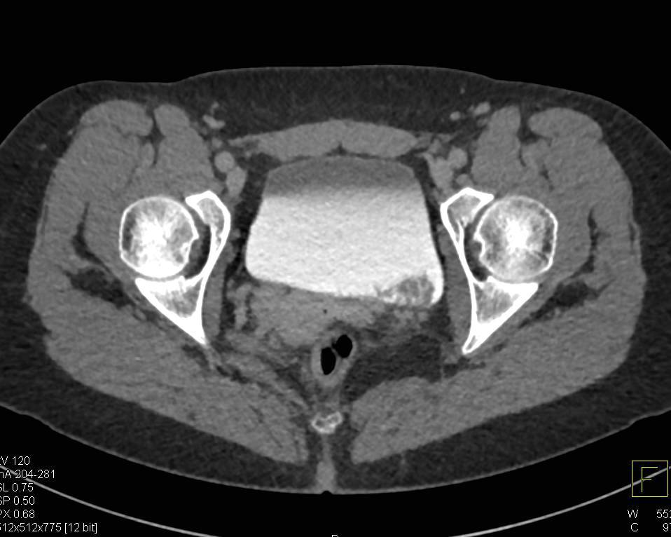 Incidental Bladder Cancer - CTisus CT Scan