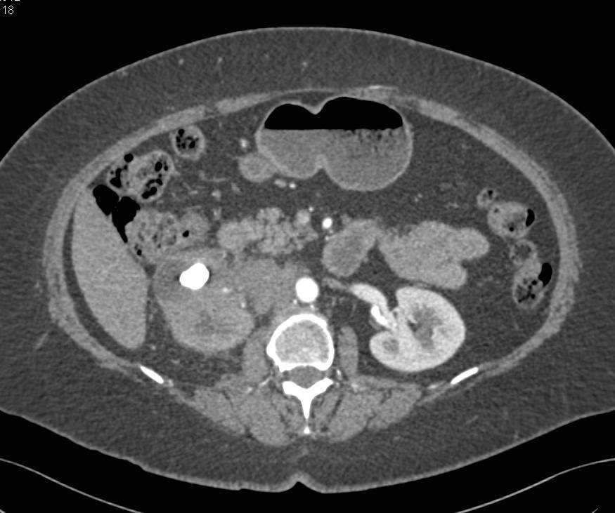 Transitional Cell Carcinoma Right Kidney Simulates Xanthogranulomatous Pyelonephritis (XGP) - CTisus CT Scan