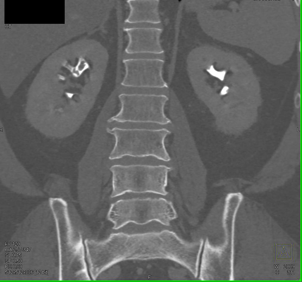 Papillary Necrosis Best Seen on 3D CT in Excretory Phase Imaging - CTisus CT Scan