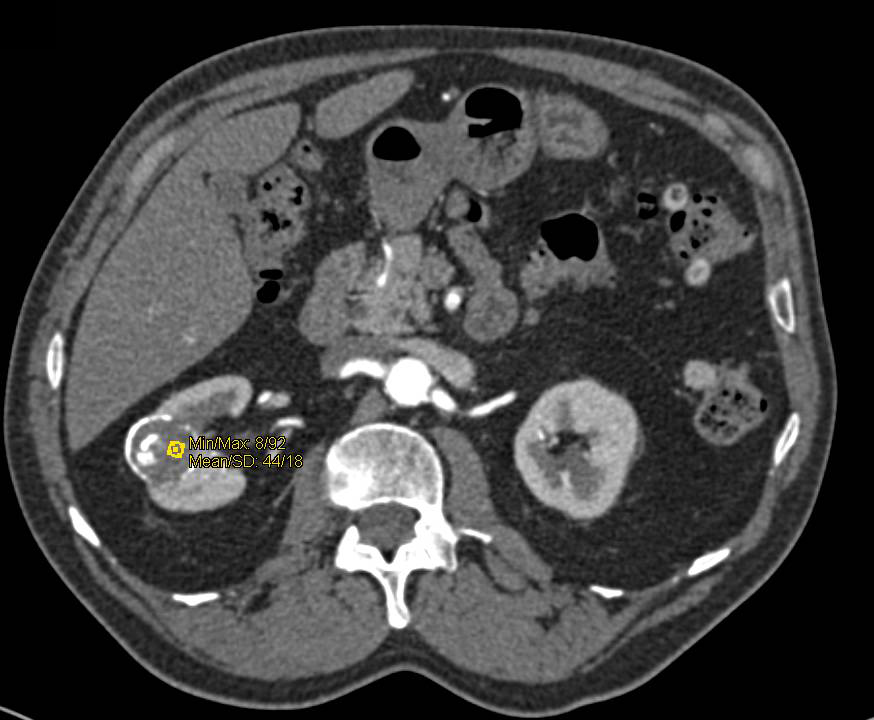 Bosniak 2F Cyst Right Kidney - CTisus CT Scan