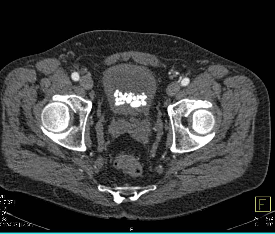 Multiple Bladder Calculi - CTisus CT Scan