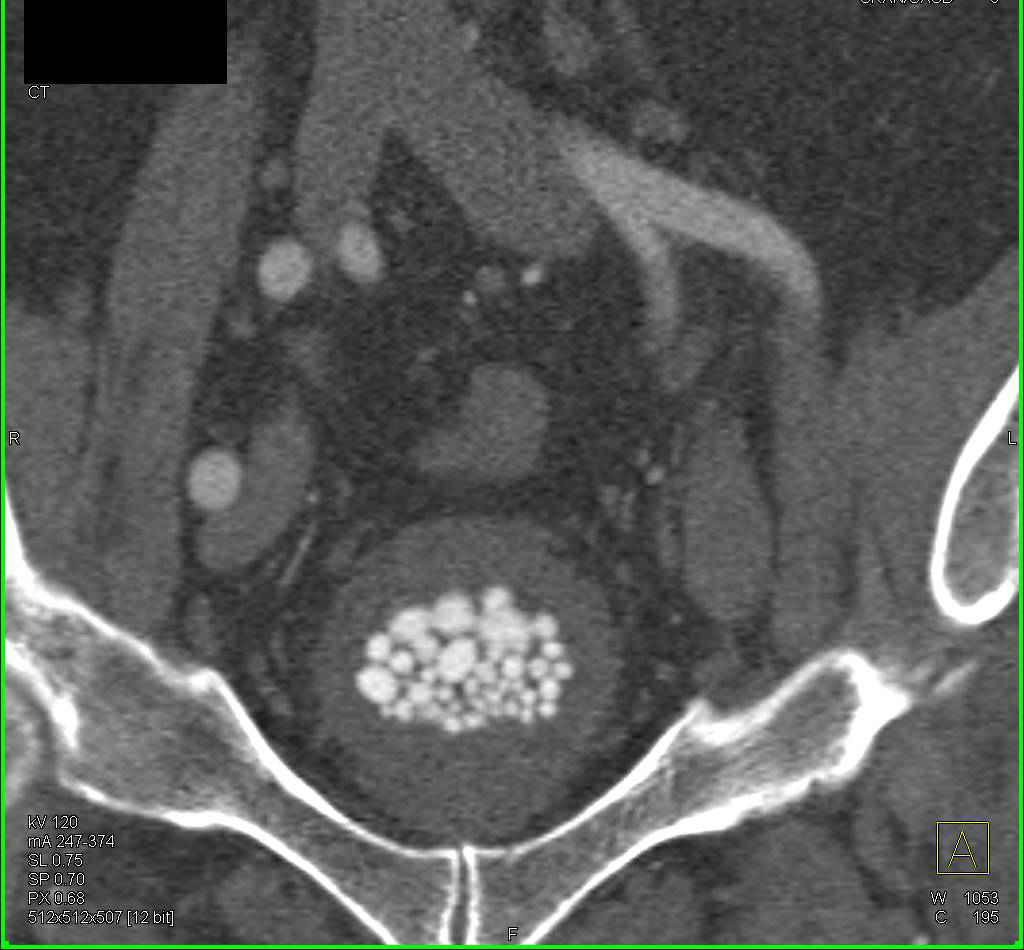 Bladder Calculi - CTisus CT Scan