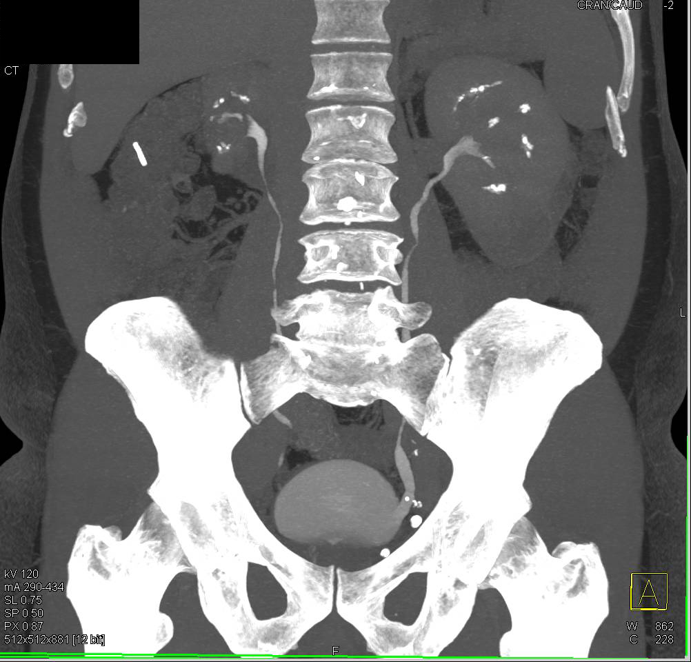 Subcapsular Hematoma Left Kidney due to Prior Biopsy - CTisus CT Scan