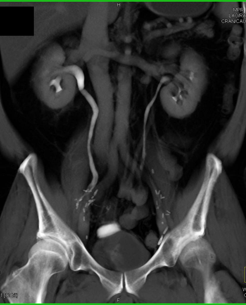 Blood Clot in Right Ureter due to Hematuria From Stone Disease - CTisus CT Scan