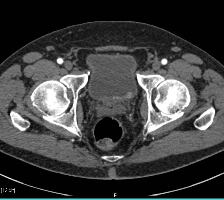 Incidental Bladder Cancer on Arterial and Delayed Phase Imaging - CTisus CT Scan