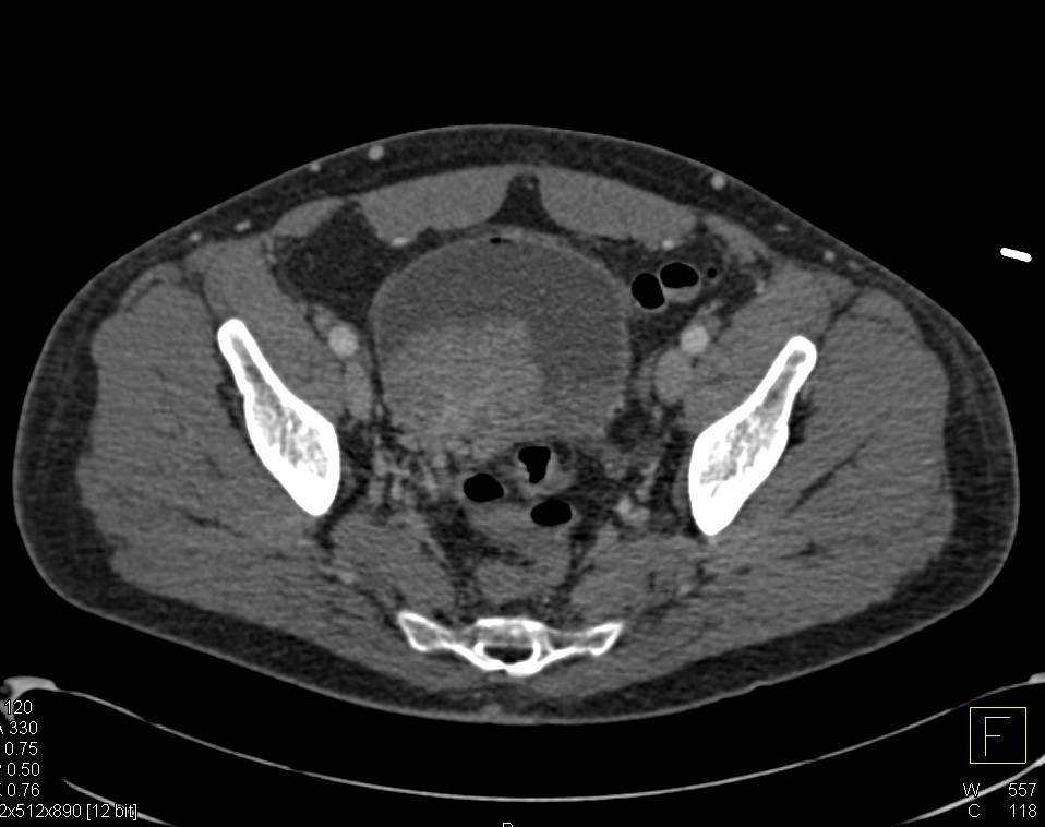 Multifocal Bladder Cancer on Early and Late Phase Imaging - CTisus CT Scan