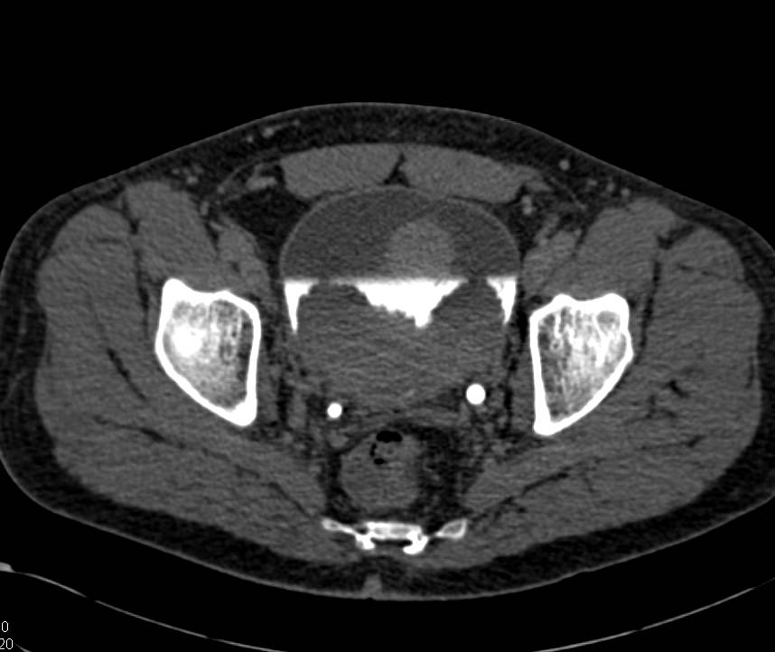 Multifocal Bladder Cancer on Early and Late Phase Imaging - CTisus CT Scan