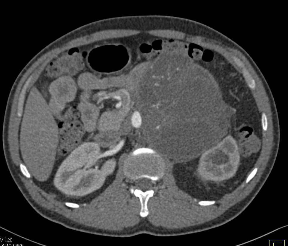 Large Germ Cell Tumor in Retroperitoneum - CTisus CT Scan