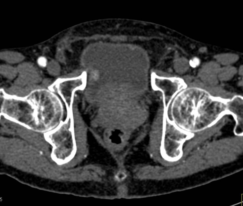 Incidental Bladder Cancer at 9 O'clock - CTisus CT Scan