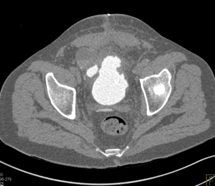 CT Cystogram with Intraperitoneal Contrast Extravasation - CTisus CT Scan