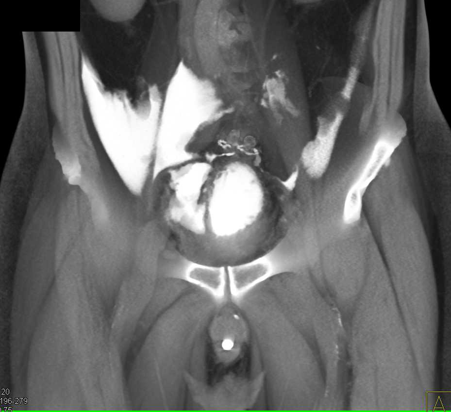 CT Cystogram with Intraperitoneal Contrast - CTisus CT Scan