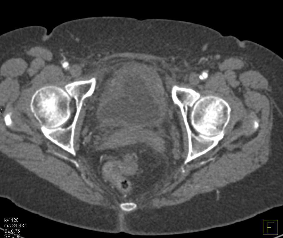 Incidental Bladder Cancer - CTisus CT Scan