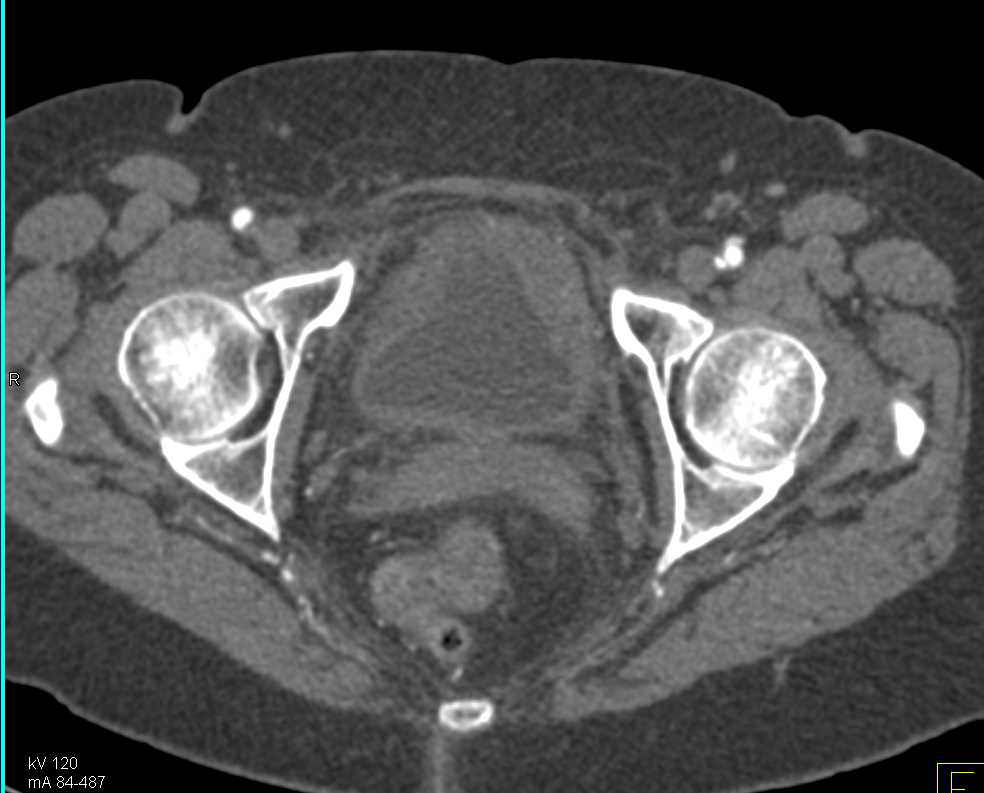 Bladder Cancer in a Patient with a Prior Renal Transitional Cell Cancer (TCC) - CTisus CT Scan