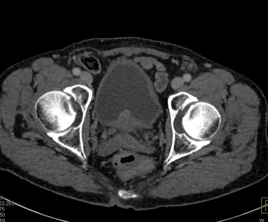 Liver Metastases from Bladder Cancer - CTisus CT Scan