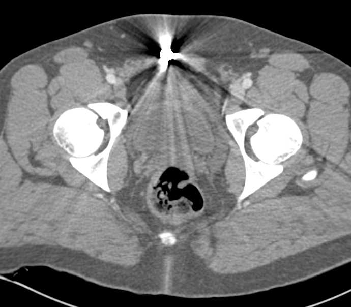 Incidental Bladder Cancer - CTisus CT Scan