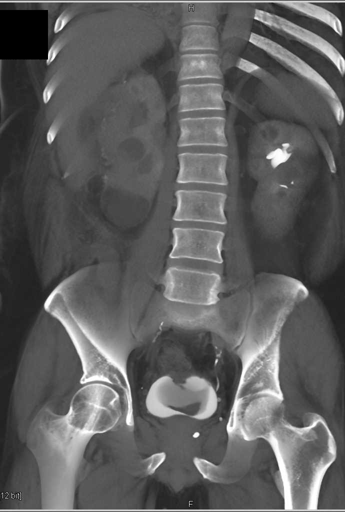 Renal Carcinoma with Bladder Hemorrhage - CTisus CT Scan