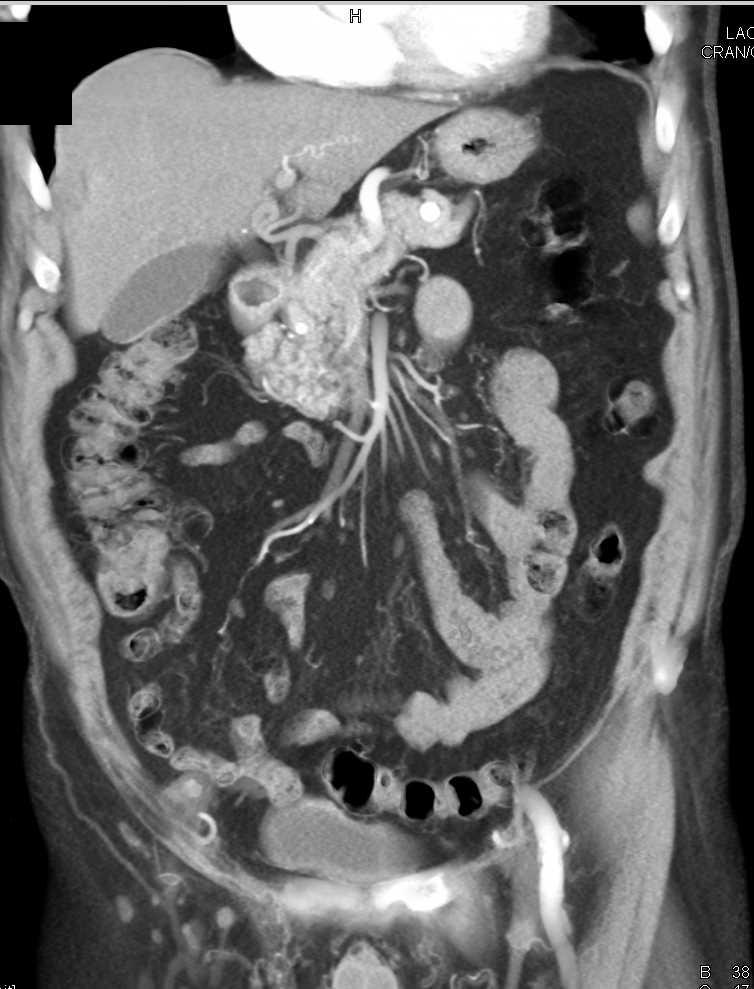 Bladder Cancer with Blood Clots in the Bladder - CTisus CT Scan