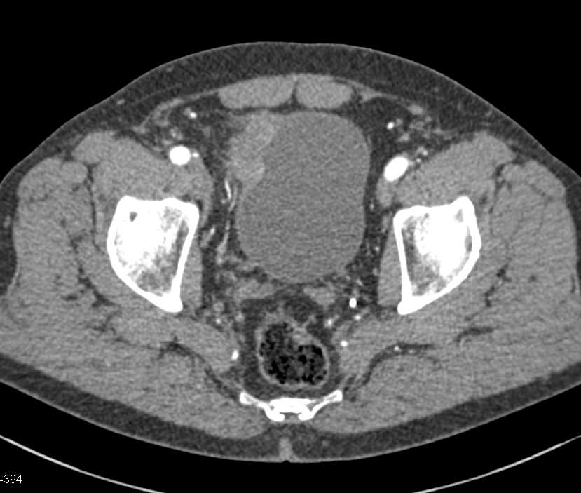 Bladder Cancer with Enhancement on Arterial Phase Imaging - CTisus CT Scan