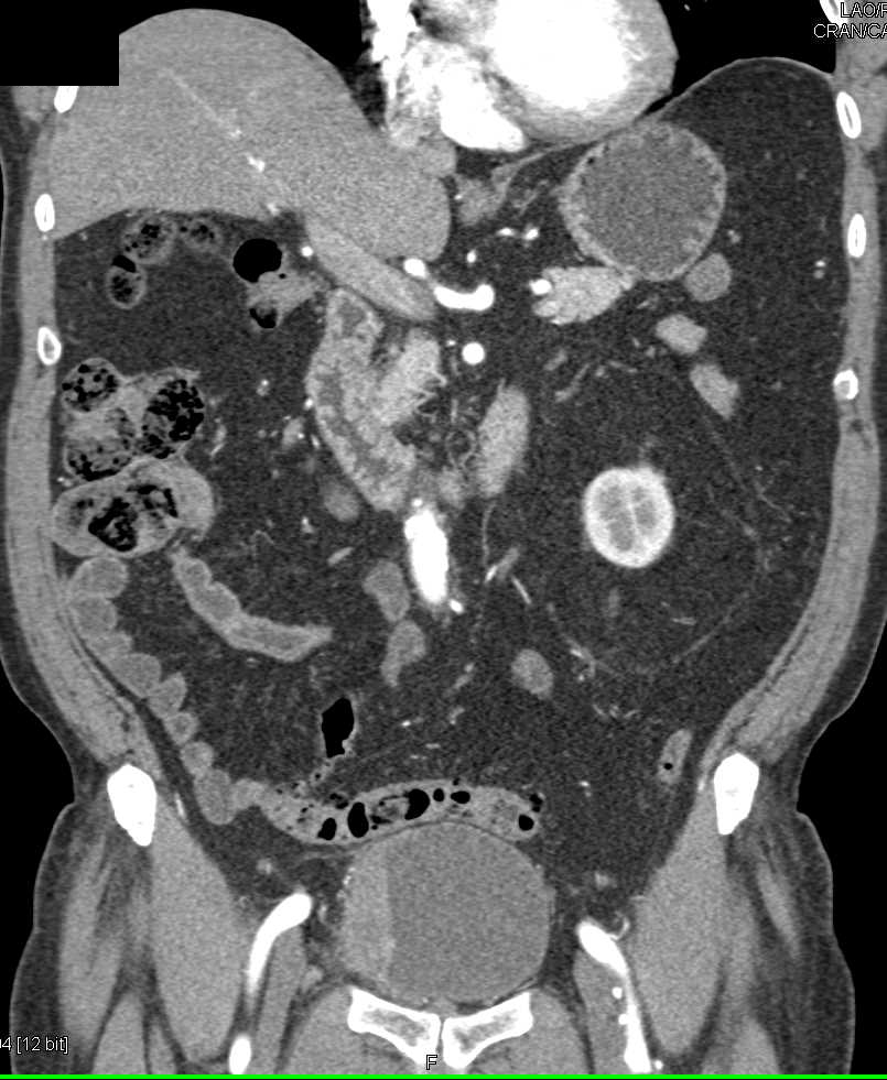 Bladder Cancer with Enhancement on Arterial Phase Imaging - CTisus CT Scan