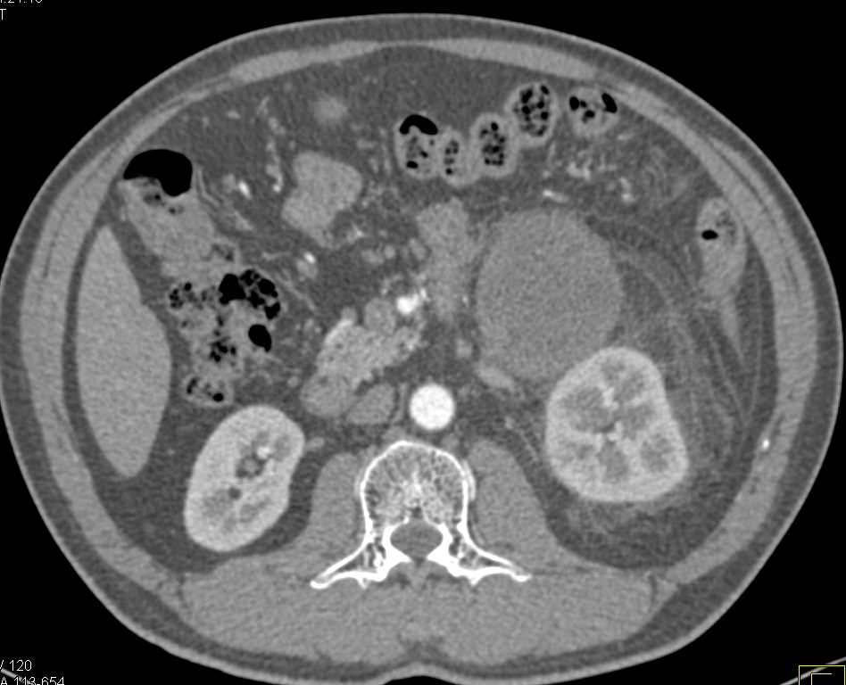 Retroperitoneal Mass due to Nodes from Testicular Cancer - CTisus CT Scan